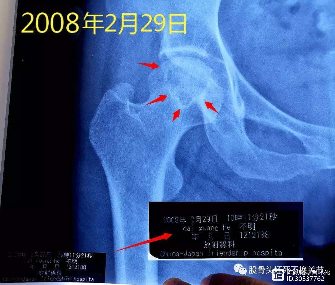 贵阳人工骨头医保报销多少(人工骨头医保报销多少比例)